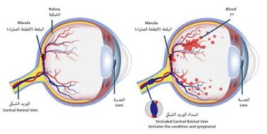 Eye Blood Vessel Clot, Plaque