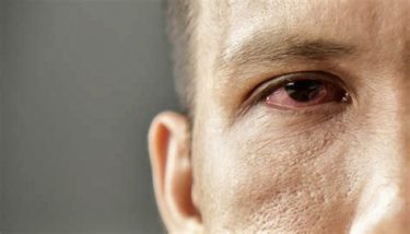 Retinal Vascular Occlusions On Vaccinated