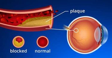 Eye Blood Vessel Clot, Plaque