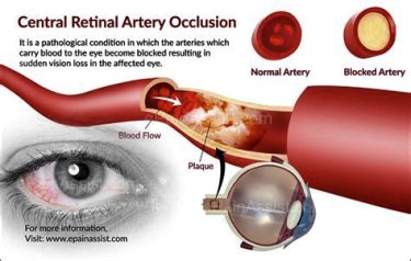 Eye Blood Vessel Clot, Plaque